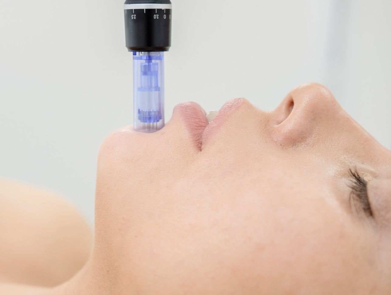 Microneedling facial aplicado en el módulo práctico de EK