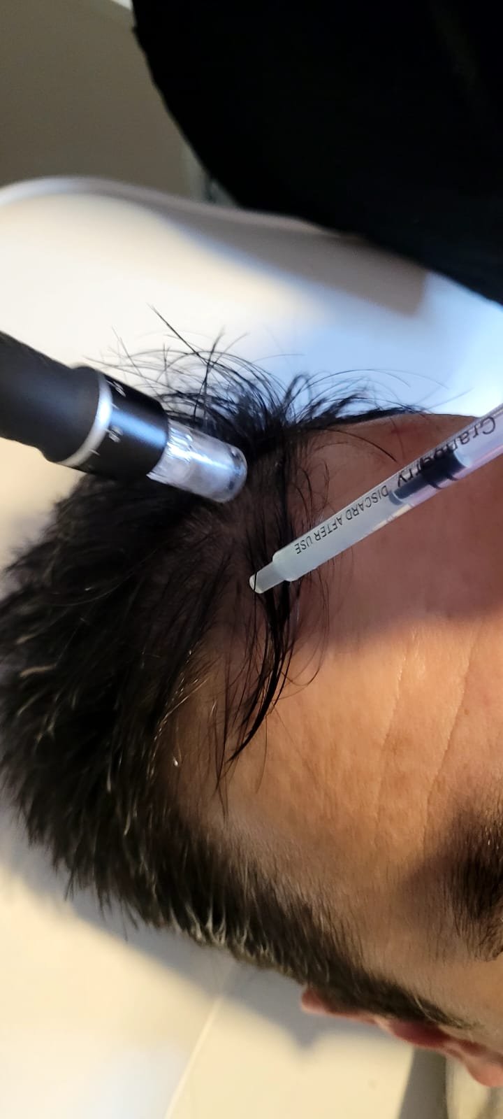 Procedimiento real de microneedling de cuero cabelludo, grabado para el curso