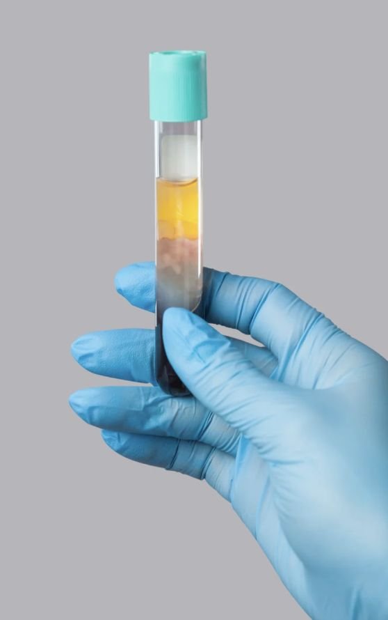 Tubo de PRP ya centrifugado, plasma separado de glóbulos rojos